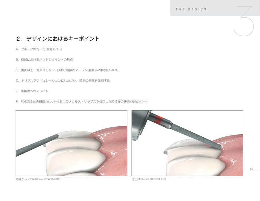 ラミネートベニア スマイルデザインのレシピ20