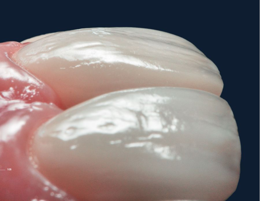 ラミネートベニア スマイルデザインのレシピ20