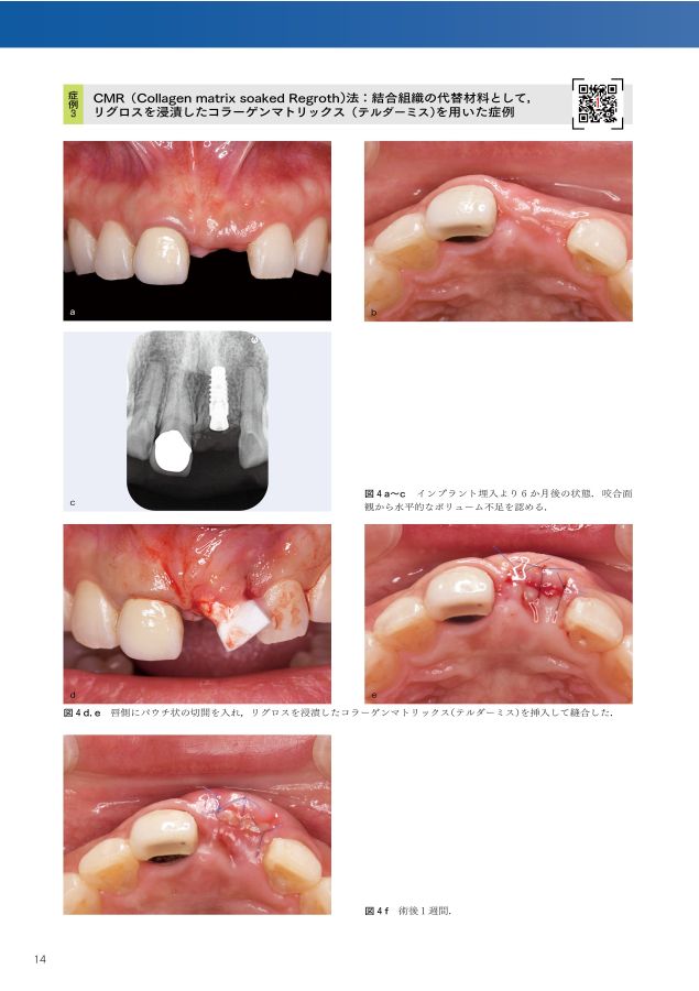 歯周・インプラント治療における再生療法