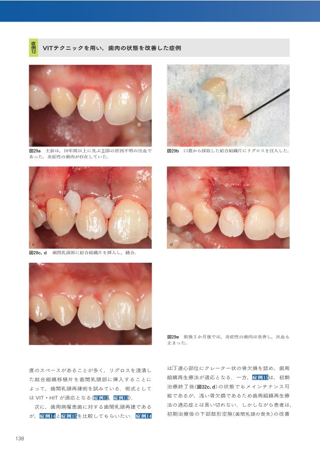 歯周・インプラント治療における再生療法