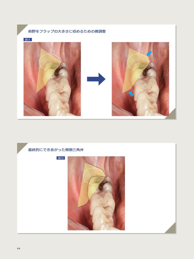 科学的根拠に基づいたビジュアル下顎埋伏智歯抜歯