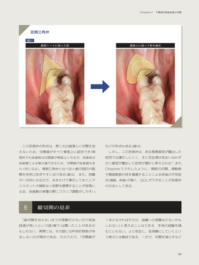 科学的根拠に基づいたビジュアル下顎埋伏智歯抜歯