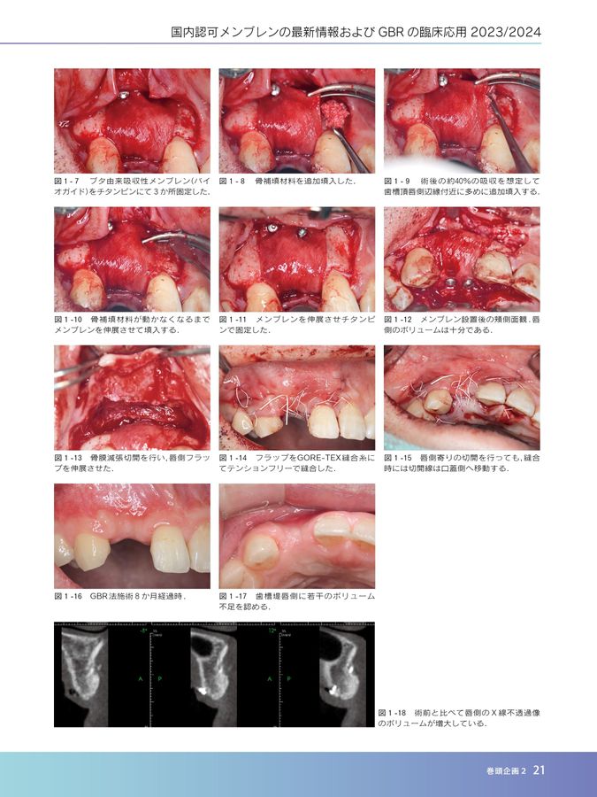 TQ別冊骨補填材料＆メンブレンYB2023／2024