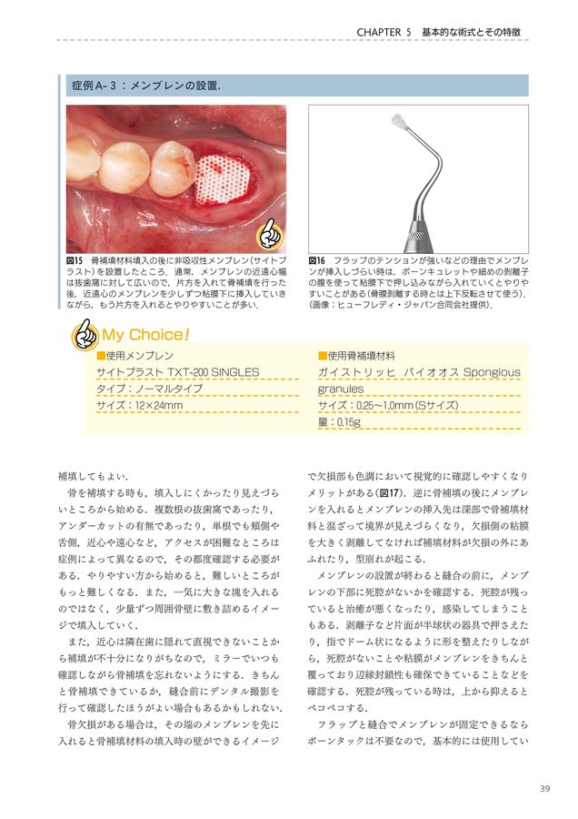 必ず上達　ソケットプリザベーション 必ず上達 ソケットプリザベーション: インプラント初心者でも