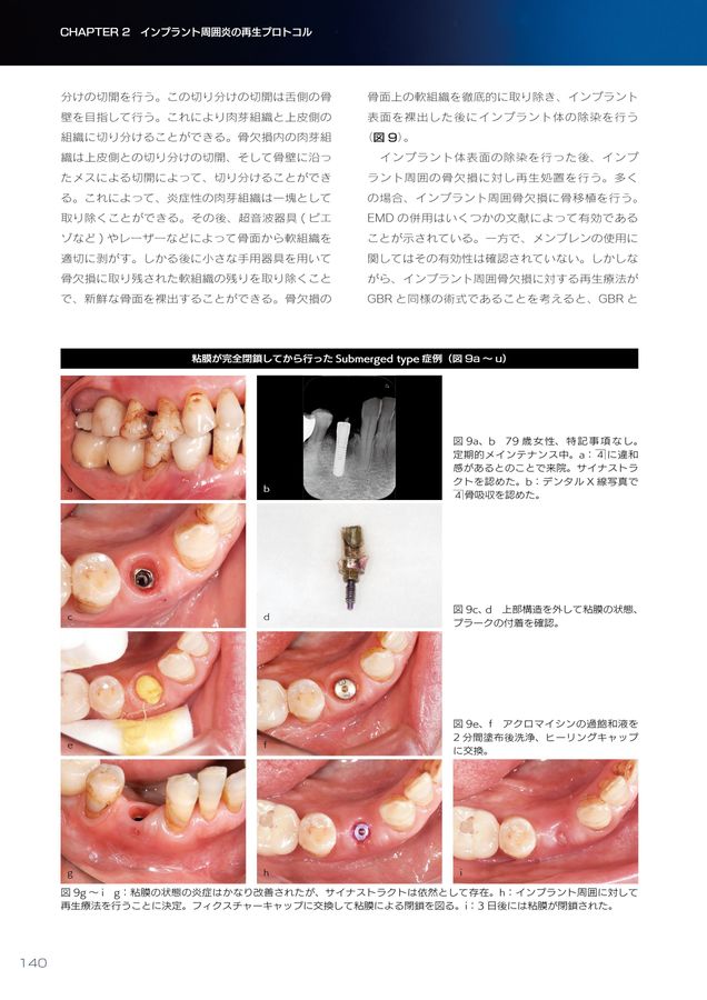 インプラント周囲炎ゼロコンセプト