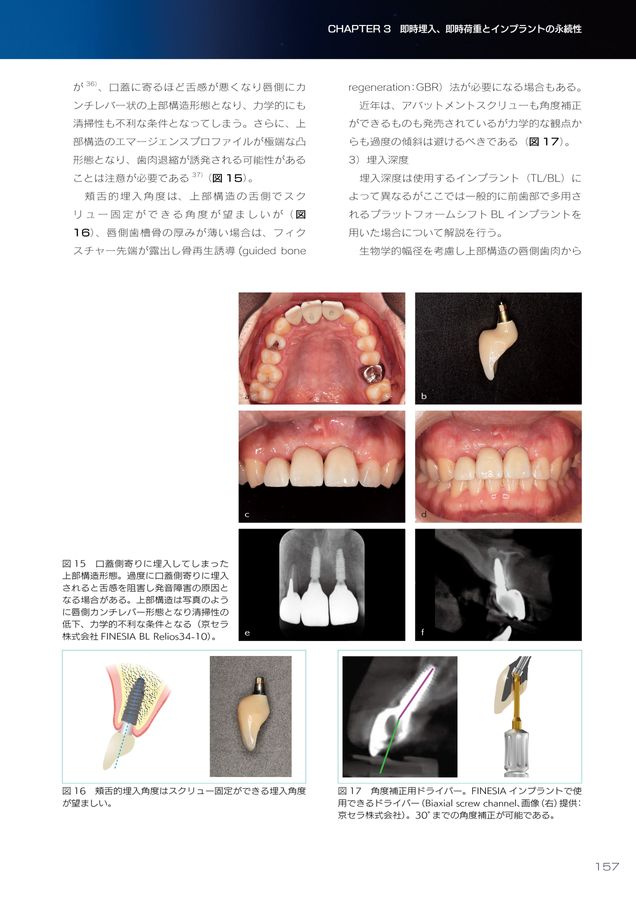 【裁断済み】インプラント周囲炎ゼロコンセプト インプラント周囲炎ゼロコンセプト: 科学的根拠に基づいた多角的