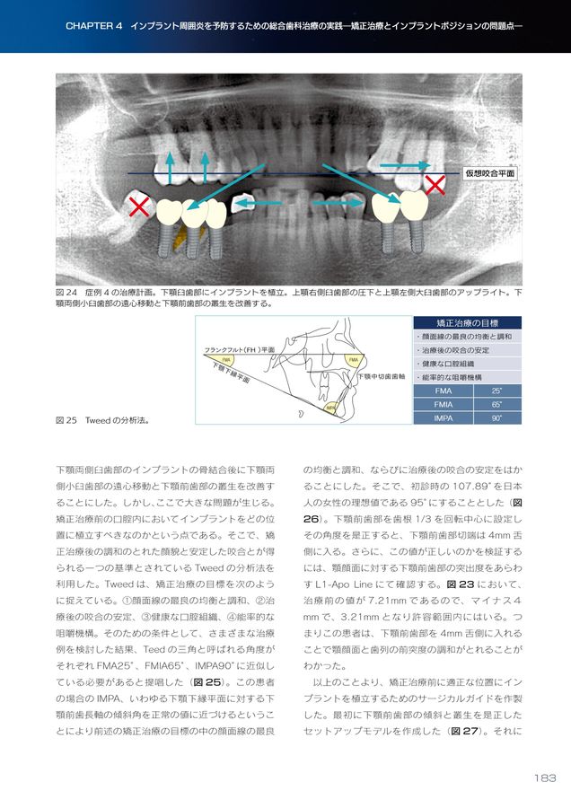 インプラント周囲炎ゼロコンセプト