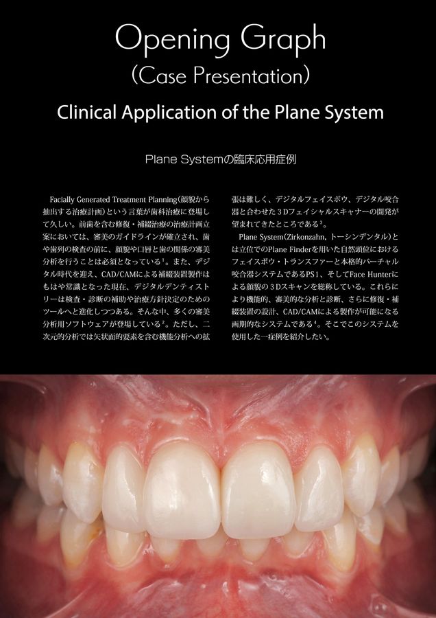 イノベーション・オブ・ラミネートベニア