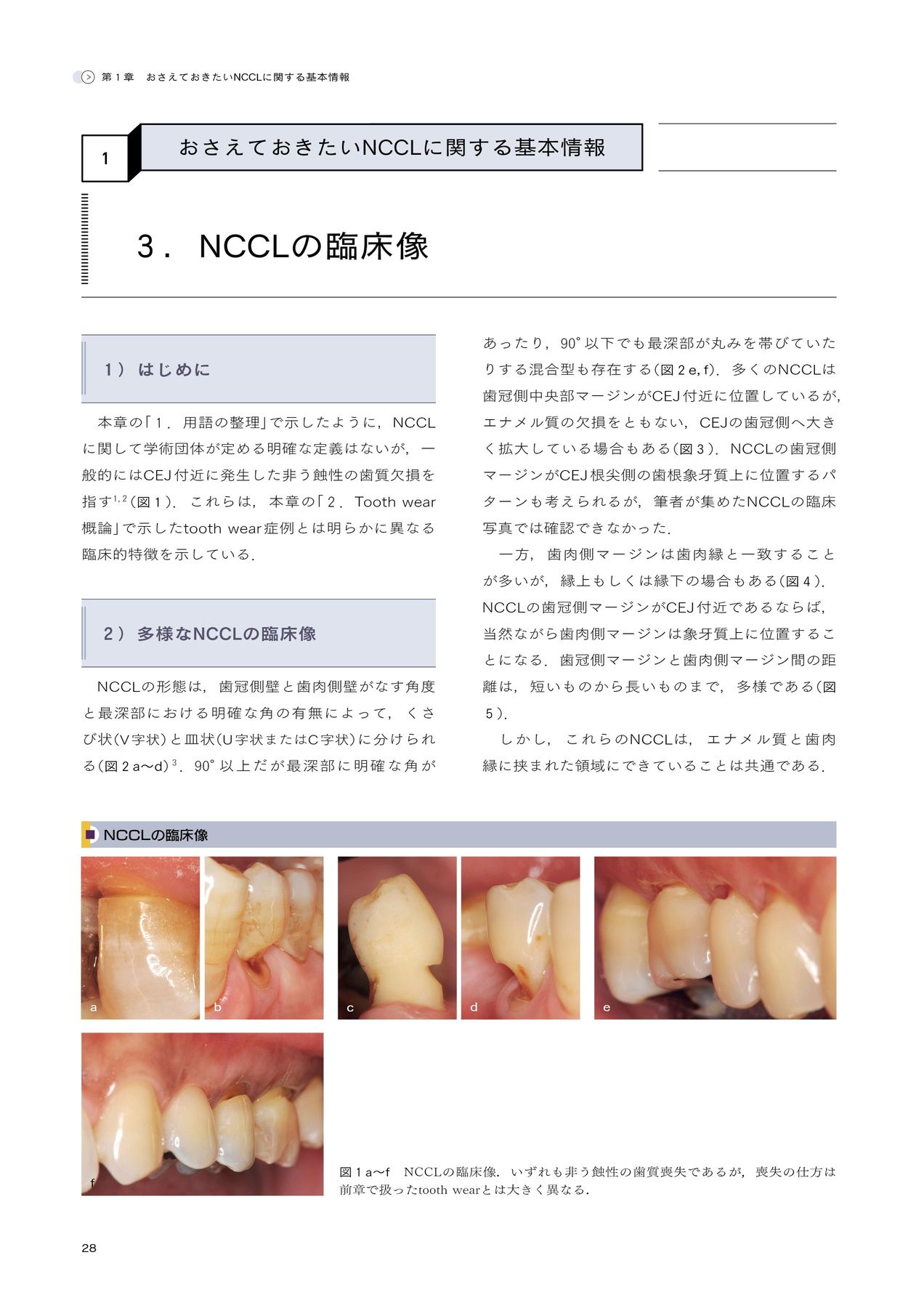 【美品】非う蝕性歯頸部歯質欠損NCCL 非う蝕性歯頸部歯質欠損 NCCL