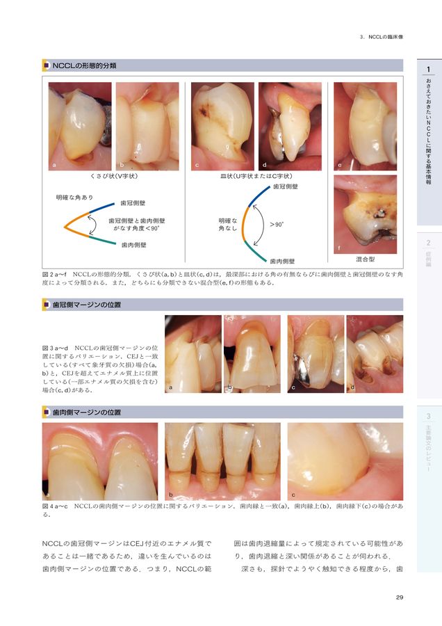 非う蝕性歯頸部歯質欠損NCCL = Noncarious Cervical L… 非う蝕性歯頸部歯質欠損 NCCL