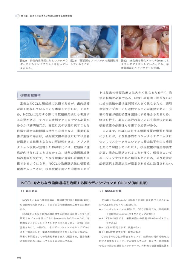 非う蝕性歯頸部歯質欠損 NCCL