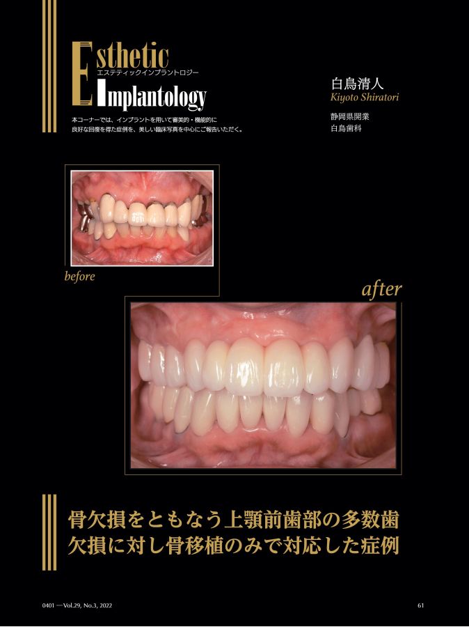 デンタルインプラントロジー2022 全巻 Quintessence DENTAL Implantology 2022年No.3 - クインテッセンス出版