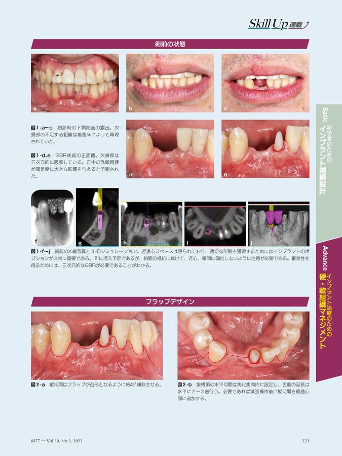 Quintessence DENTAL Implantology 2023年No.3