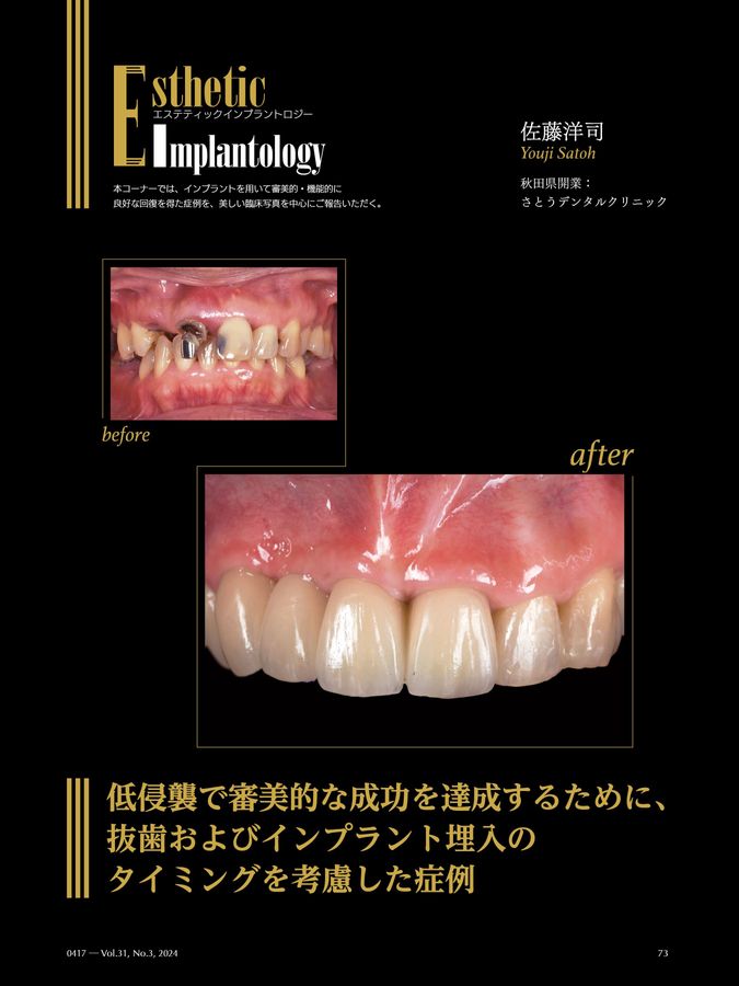 【裁断済み】インプラントレストレーション vol. III 歯界展望別冊 モノリシックジルコニアレストレーション [雑誌