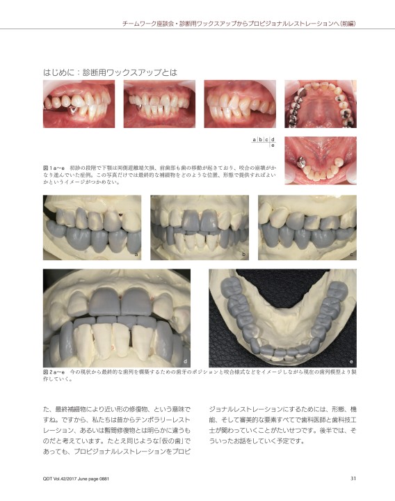 歯牙模型 補綴 歯科 下顎遊離端欠損 Title