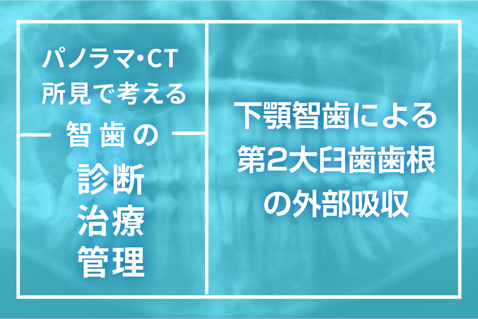 第2回 下顎智歯による第2大臼歯歯根の外部吸収