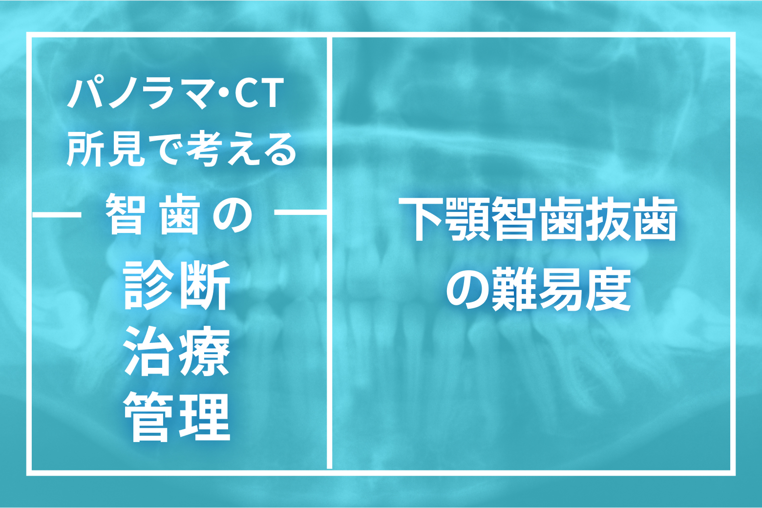 第3回 下顎智歯抜歯の難易度