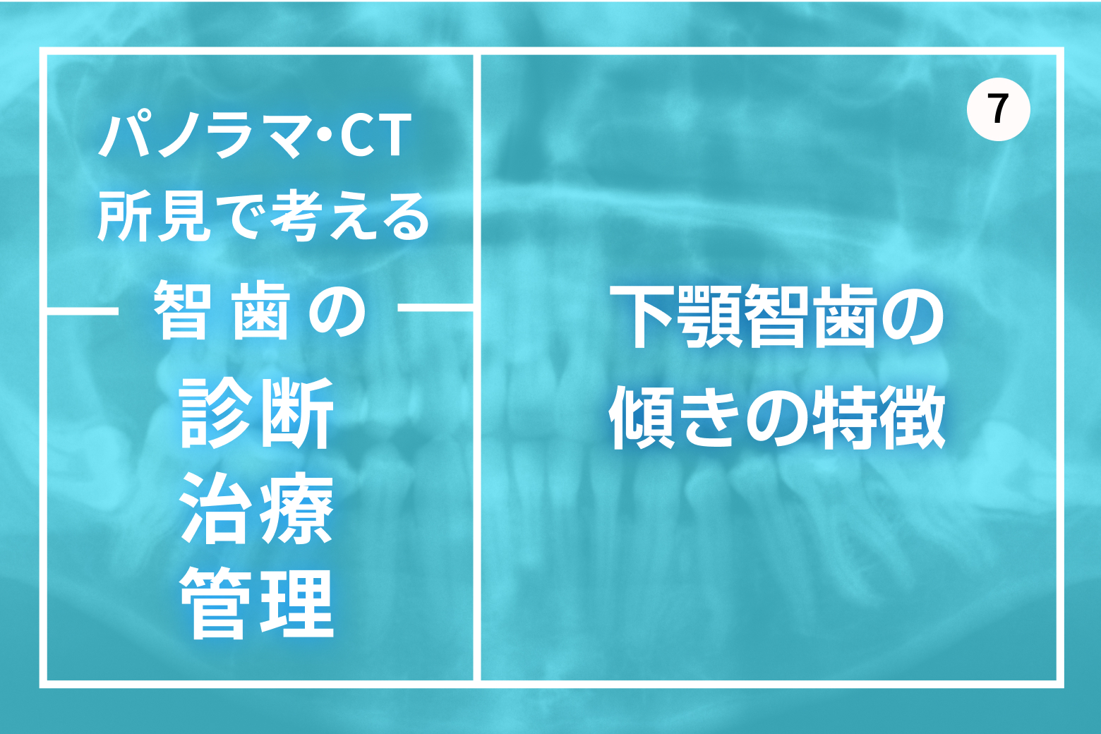 第7回 下顎智歯の傾きの特徴
