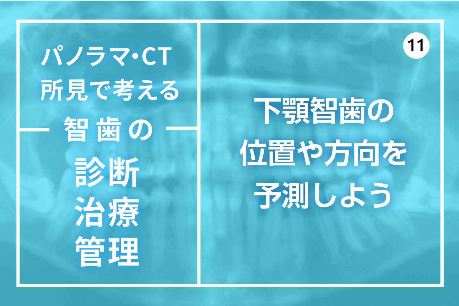 第11回 下顎智歯の位置や方向を予測しよう