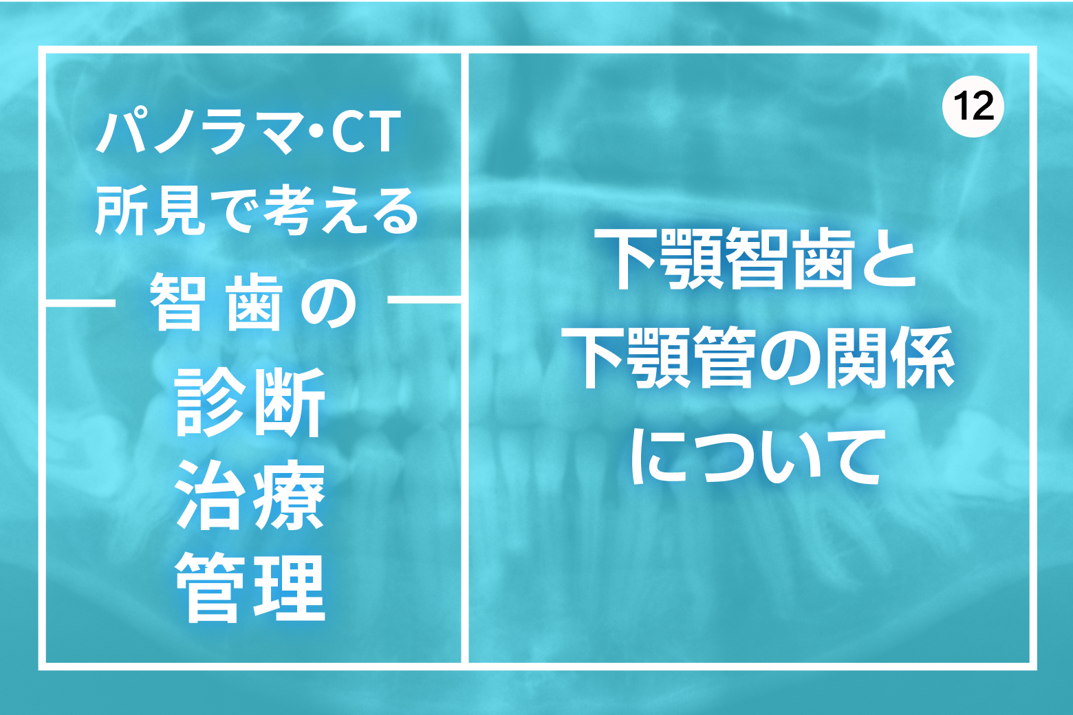 第12回 下顎智歯と下顎管の関係について