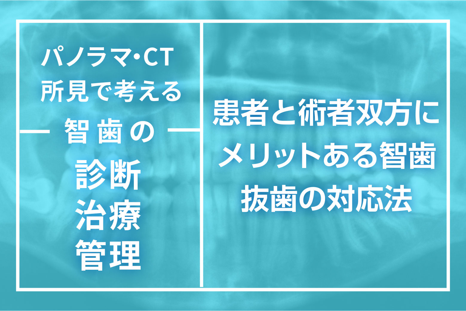 第15回（最終回） 患者と術者双方にメリットある智歯抜歯の対応法