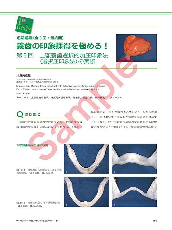 FOCUS：短期連載（全3回） 義歯の印象採得を極める！ 第3回