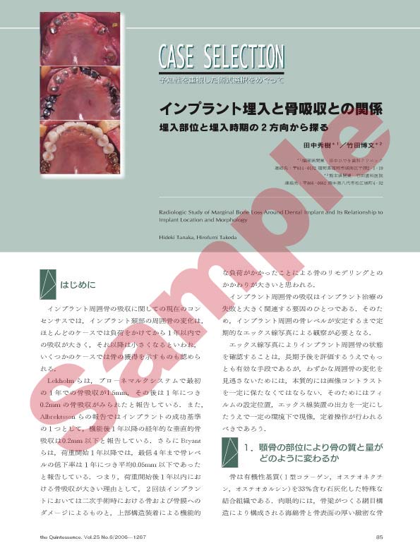 CASE SELECTION:インプラント埋入と骨吸収との関係 埋入部位と埋入時期の2方向から探る