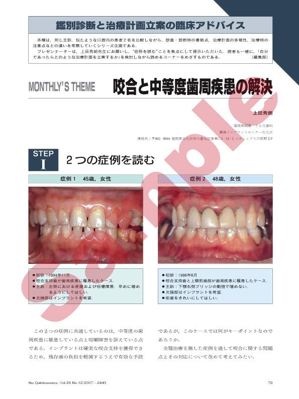 鑑別診断と治療計画立案の臨床アドバイス：咬合と中等度歯周疾患