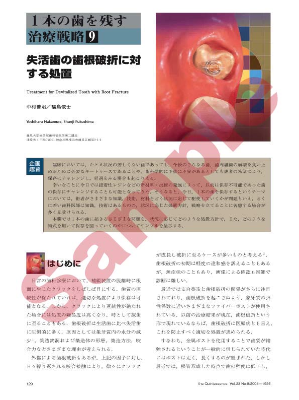 1本の歯を残す治療戦略[9]:失活歯の歯根破折に対する処置