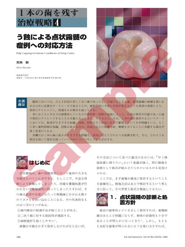 歯界展望 126巻4号 歯髄を残す ~露髄の可能性の高い深在性齲蝕への対応を再考する~ 1本の歯を残す治療戦略[4]:う蝕による点状露髄の症例への対応方法